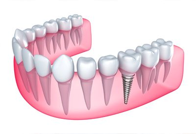 zubni-implanti3